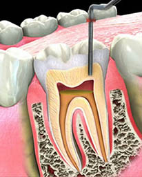 root canal tijuana